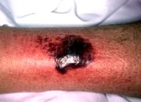 pyoderma