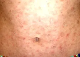chronica Pityriasis