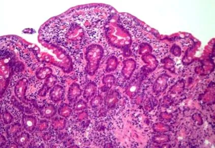 pyoderma gangrenosum