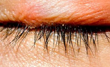 chalazion