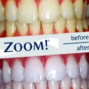 whitening zoom
