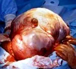 abdominale