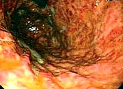 hidrogen