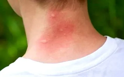 allergiás-e
