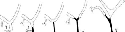 stricturi