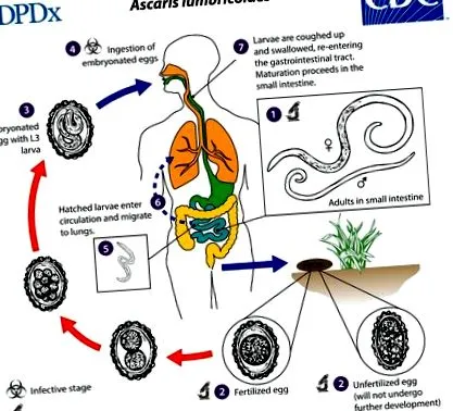 ascariasis