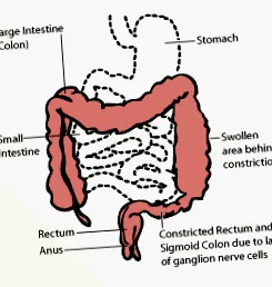 hirschsprung