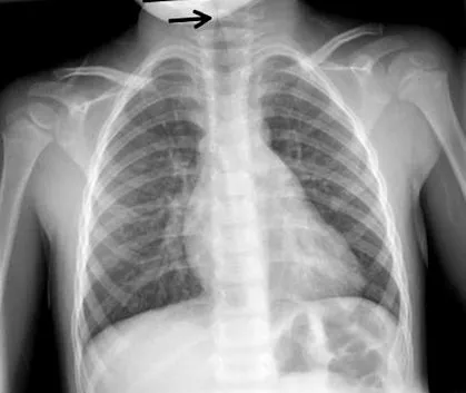 laryngotracheitis