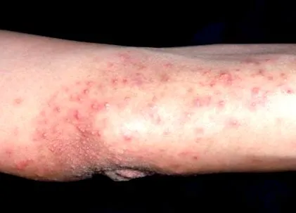 dermatitis