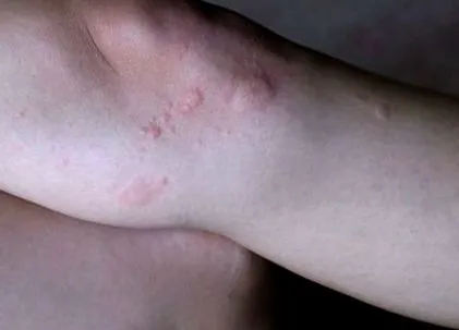 urticaria