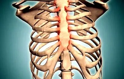 costochondritis