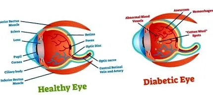 diabéteszes retinopathia