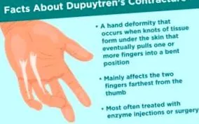 contracture