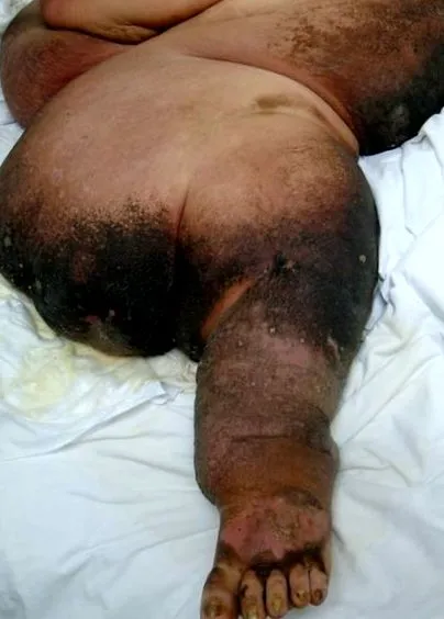 elephantiasis