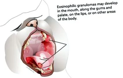granulómakomplexum