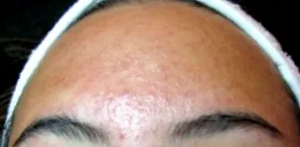 folliculitis