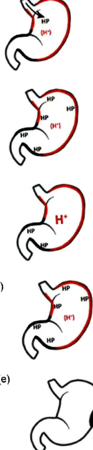 интимни helicobacter