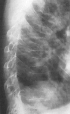 hipercortizolismul