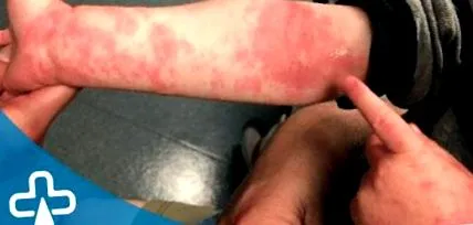 eczemelor