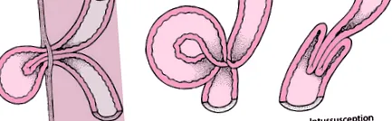 intestinală