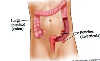 diverticuloză