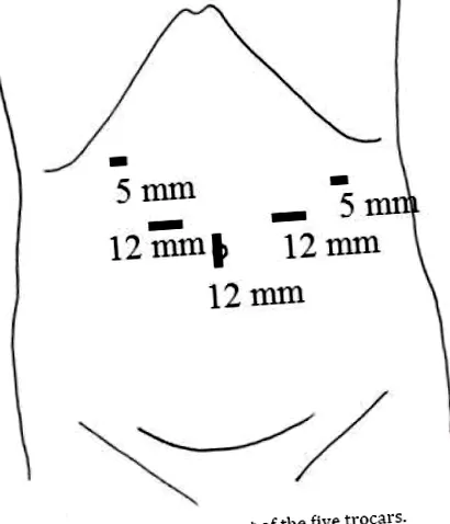 pancreaticojejunostomie