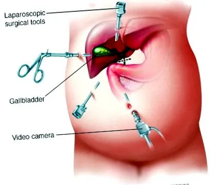 laparoscopica