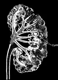 burete medular