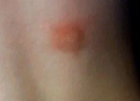 Mastocitoza sistemică