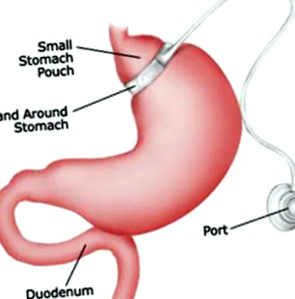 hepatice