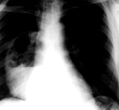 pulmonare