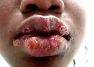 herpes
