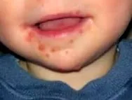 dermatitis