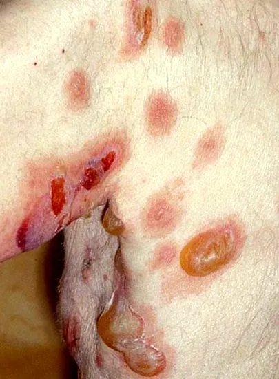 ръководства pemphigus