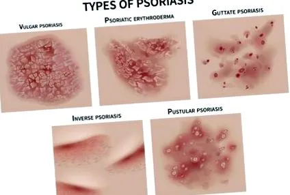 psoriazis