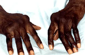 rheumatoid