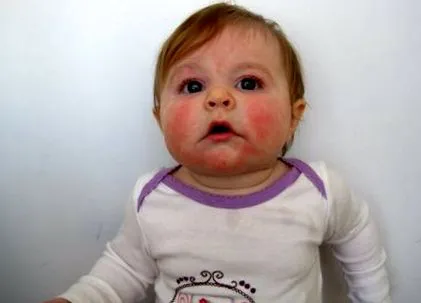 atópiás dermatitis