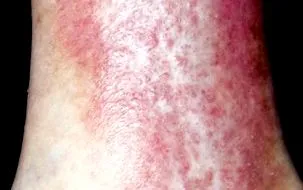 varicoase