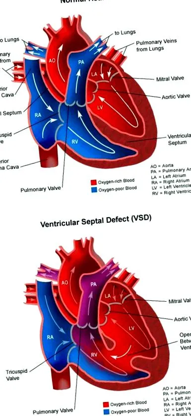 ventricular