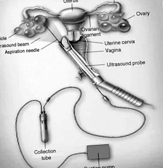 recuperarea