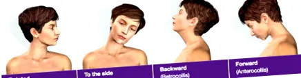 cervical