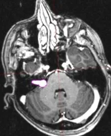 neurom