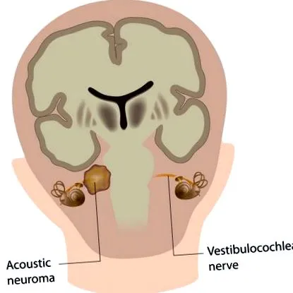 neurom