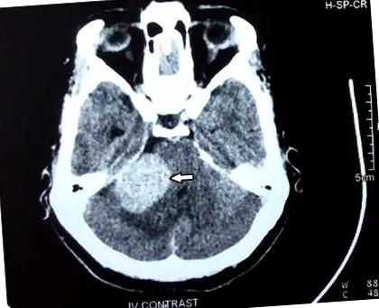 neuroma