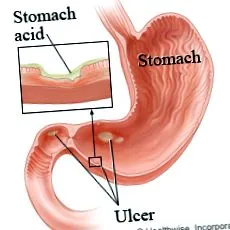 bacteriană
