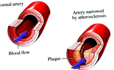 ateroscleroza