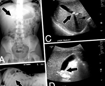 epekő