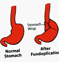 fundoplication
