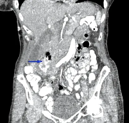 duodenal