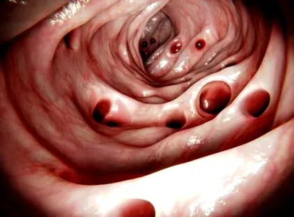 diverticulosis